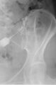 Fig. 2  Periarticular SIJ injections under fluoroscopic guidance